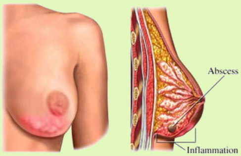 absces dojke