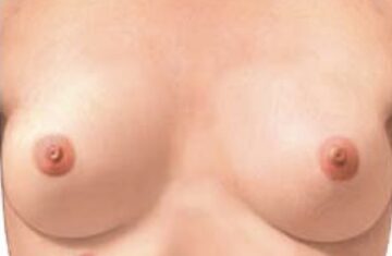 Ilustracija ženskog tijela s označenom trećom bradavicom